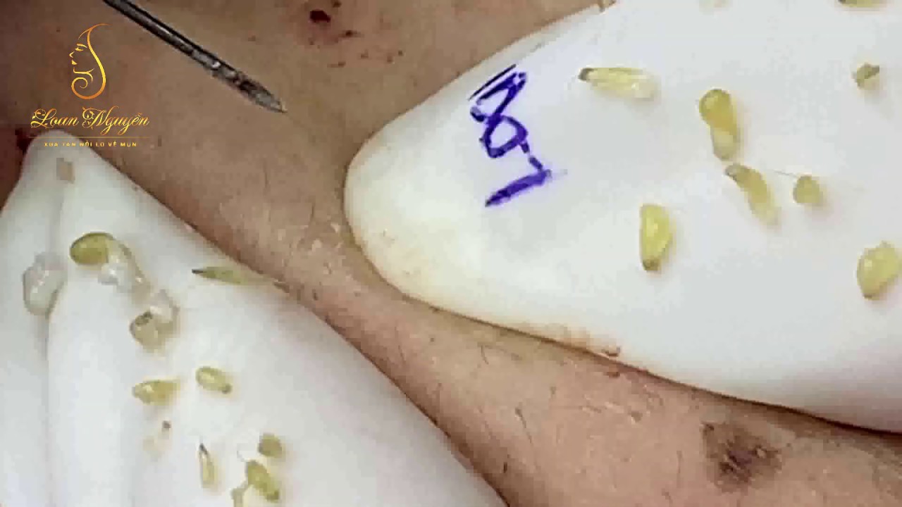 Skin care_ REMOVAL BLACKHEADS (89) | Loan Nguyen - YouTube