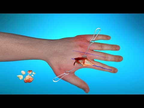 Surgical Treatment For Rheumatoid Arthritis Of Hands