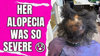 Her Alopecia was so severe it started affecting the back of her head too| Alopecia cover up
