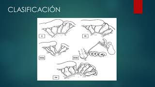 14 Avances en atresia intestinal 14 Avances en atresia intestinal