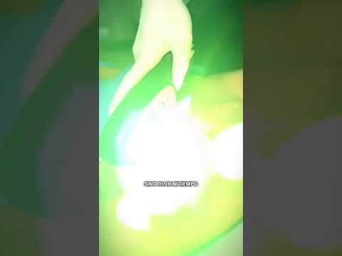 Luz Pulsada (IPL) Alma Harmony | Clínica AGL