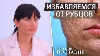 Как удалить шрамы и рубцы на лице после акне (постакне). Лазерная шлифовка после угрей и прыщей