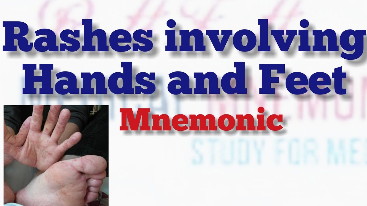 Rashes Involving Hands And Feet Mnemonic Medical Mnemonic 151 Youtube