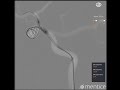 Mentice Neurovascular Brain Aneurysm Coiling Demo