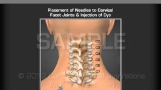 Image Guide Cervical Facet Joint Injection
