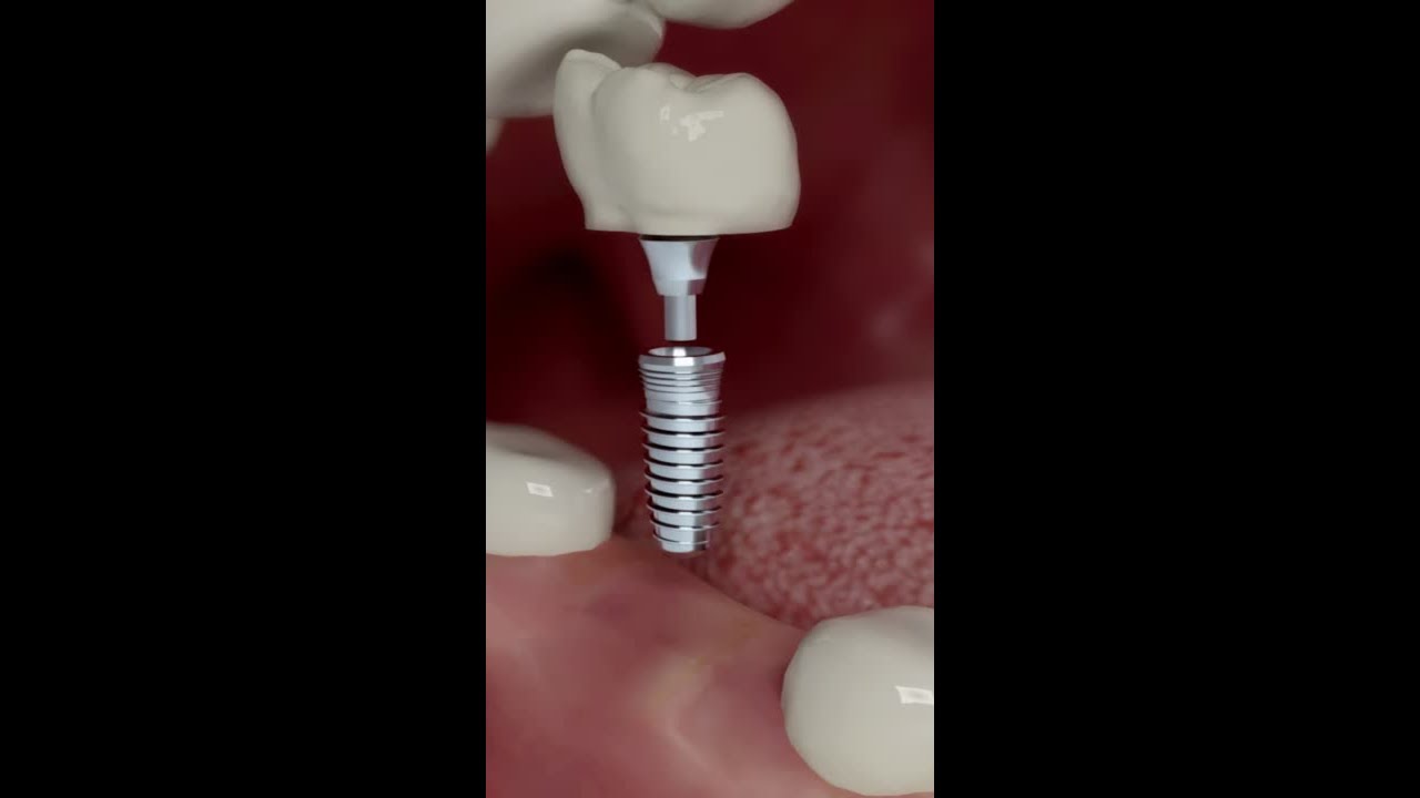 Dental Implant Treatment Process