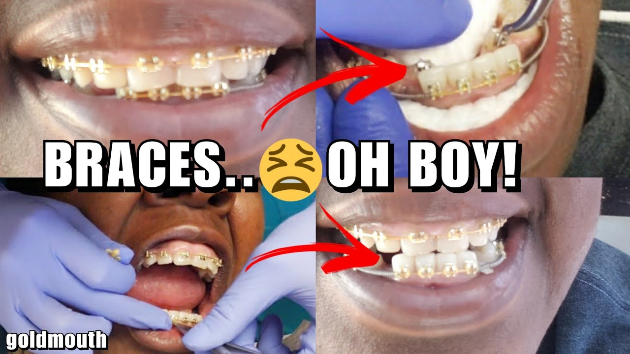 BRACES TIGHTENING.. 2ND TIME / GOLDMOUTH100 BRACES UPDATE YouTube
