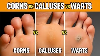 How to Tell the Difference Between Corns, Calluses, and Warts