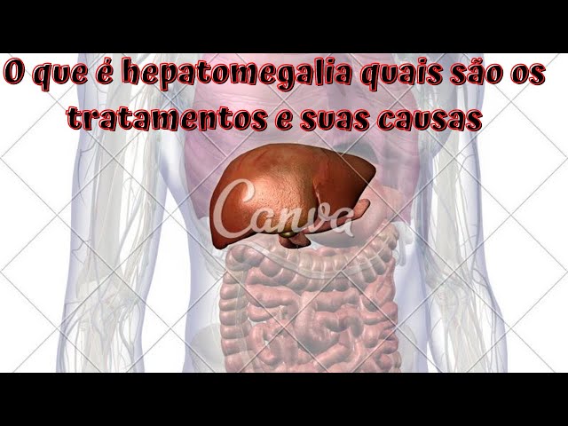 Hepatomegalia  Farmácia Saúde