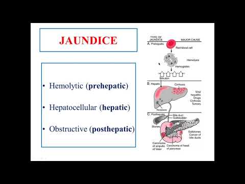 1.Hepatomegaly syndrome 2.Jaundice