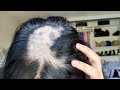 I'm going bald | Alopecia Areata (What I did to grow my hair)