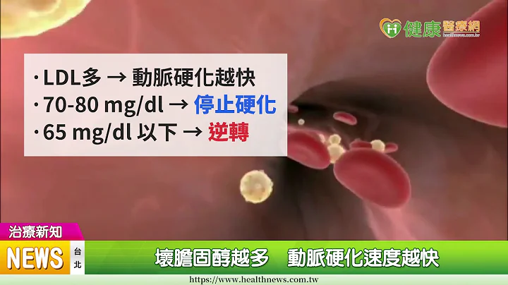 动脉硬化居然可逆转？　关键在“坏胆固醇” - 天天要闻