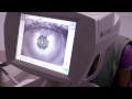 Sankara eye foundation  what is lasik