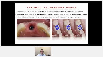 Mastering the Emergence Profile with Cervico Dr. Mark Bishara | Canadian Implant Dentistry Network