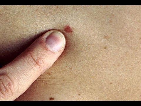 Moles not the only way to spot deadly melanoma