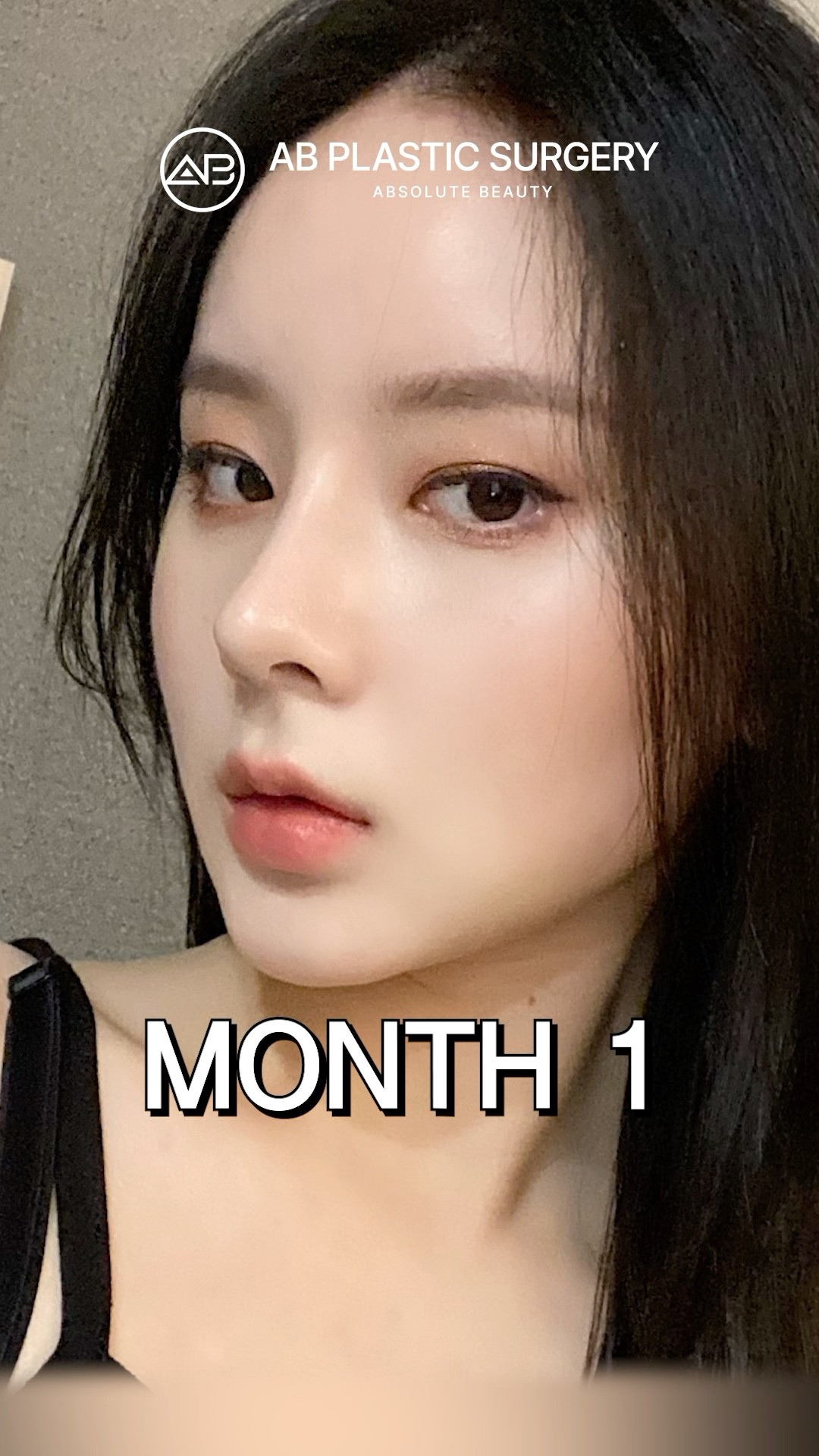 Her Korean Nose Job Shocked Everyone #koreanplasticsurgery