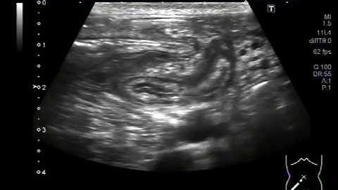Ultrasound Video showing focusing of inflamed appendix.