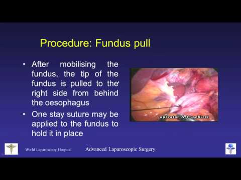 Dr R K Mishra's Lecture On Laparoscopic Fundoplication