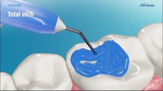 Clearfil Tri-S Bond Universal