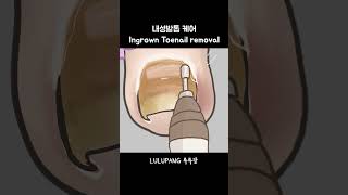 내성발톱 케어 한국인속도 Ingrown Toenail Removal