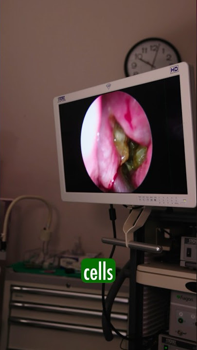 ALLERGY MYTHS! #allergies #nasal #sinus #allergy #sinusitis #mucus #entsurgeon #breathe