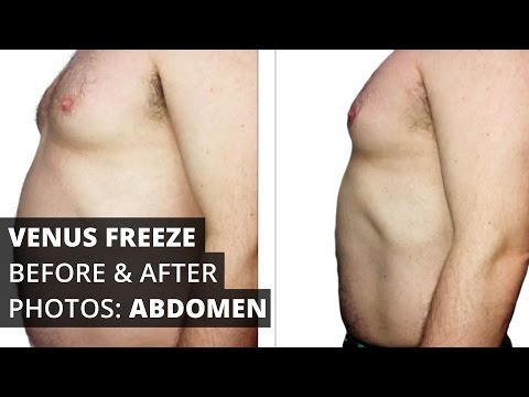 Venus Freeze™ Before & After Photos: Abdomen