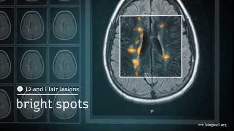 Multiple Sclerosis: Understanding Your MRI