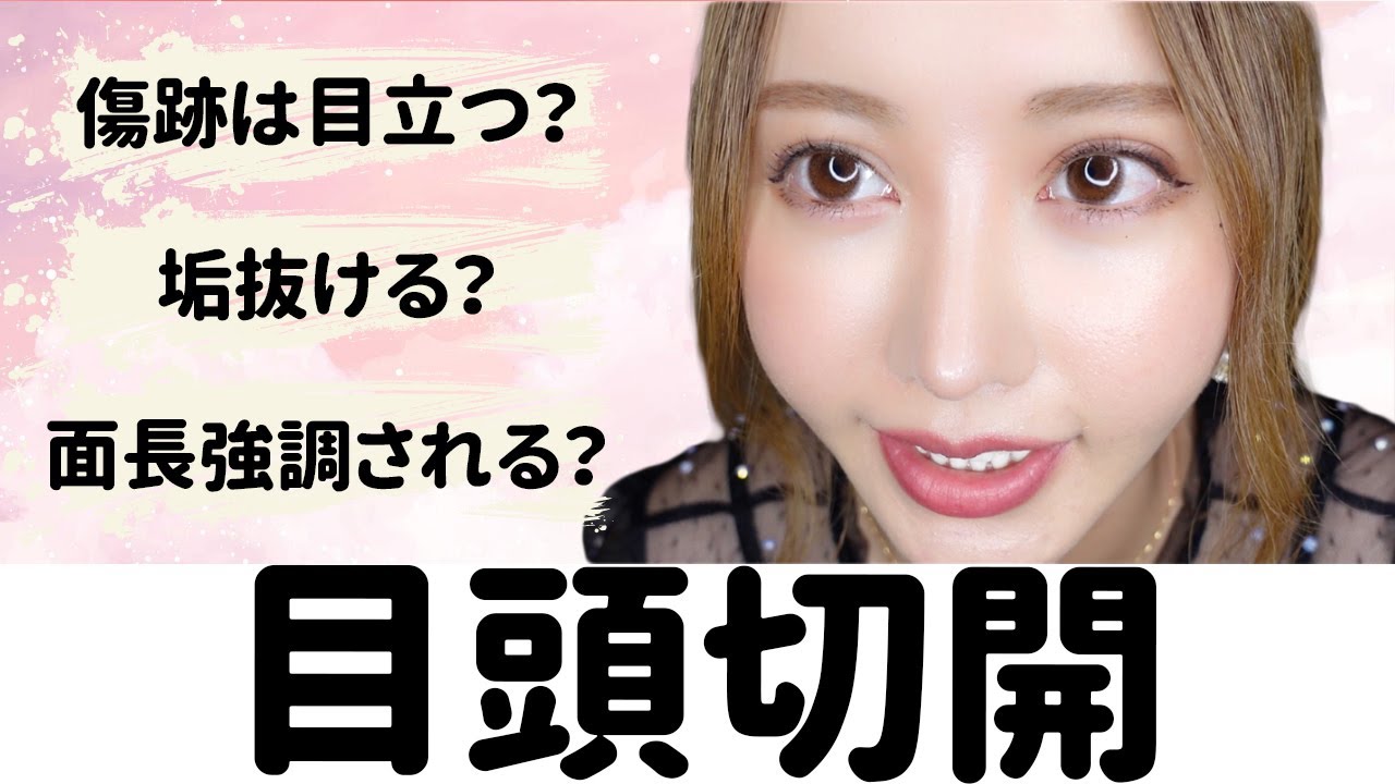 質問コーナー 目頭切開について経験者が答えます Youtube
