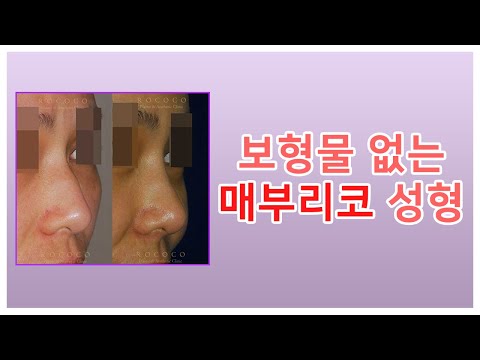 보형물 없는 매부리코성형 feat.전후사진 (before and after /hump nose /Rhinoplasty)