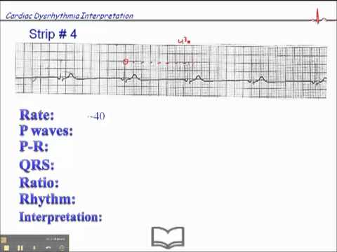 ECG: Exercise # 4