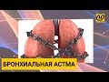 Бронхиальная астма. Как избавиться? Чем лечить? Советы врача