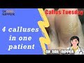 Four Calluses in One Patient #45 - Callus Tuesday