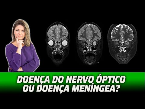 NERVOS ÓPTICOS: MUITO ALÉM DA NEURITE ÓPTICA