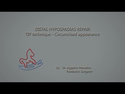 Distal Hypospadias Repair Animation