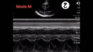 Ultrassom Pocus - E-Point Septal Separation Epss - Padrão De Normalidade