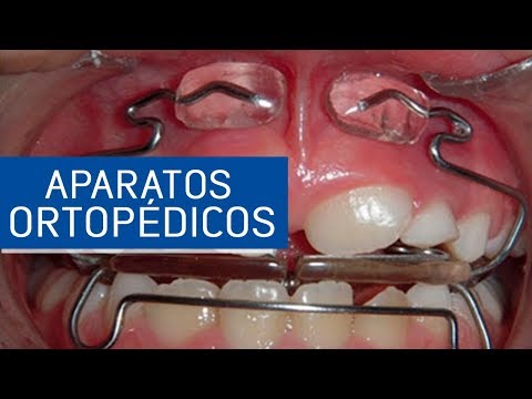 Vídeo: Alineación De Los Dientes: Colocación De Aparatos Ortopédicos