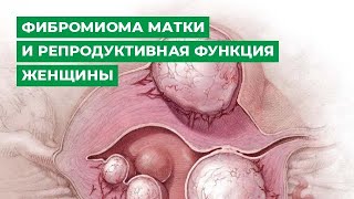 Фибромиома матки и репродуктивная функция женщины