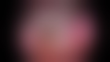 Left Laparoscopic Partial Nephrectomy