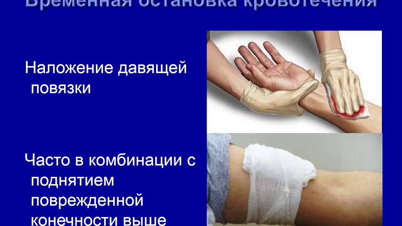 Кровотечение по форестеру