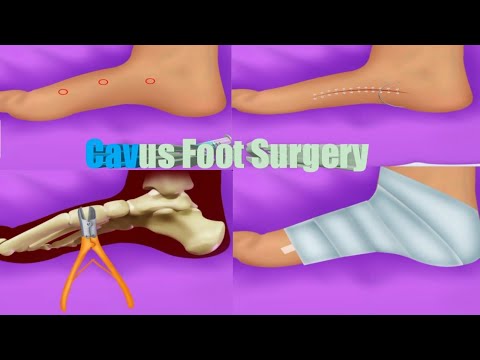 Cavus Foot Surgery Broken Foot Repair Asmr Animation Video RH ASMR