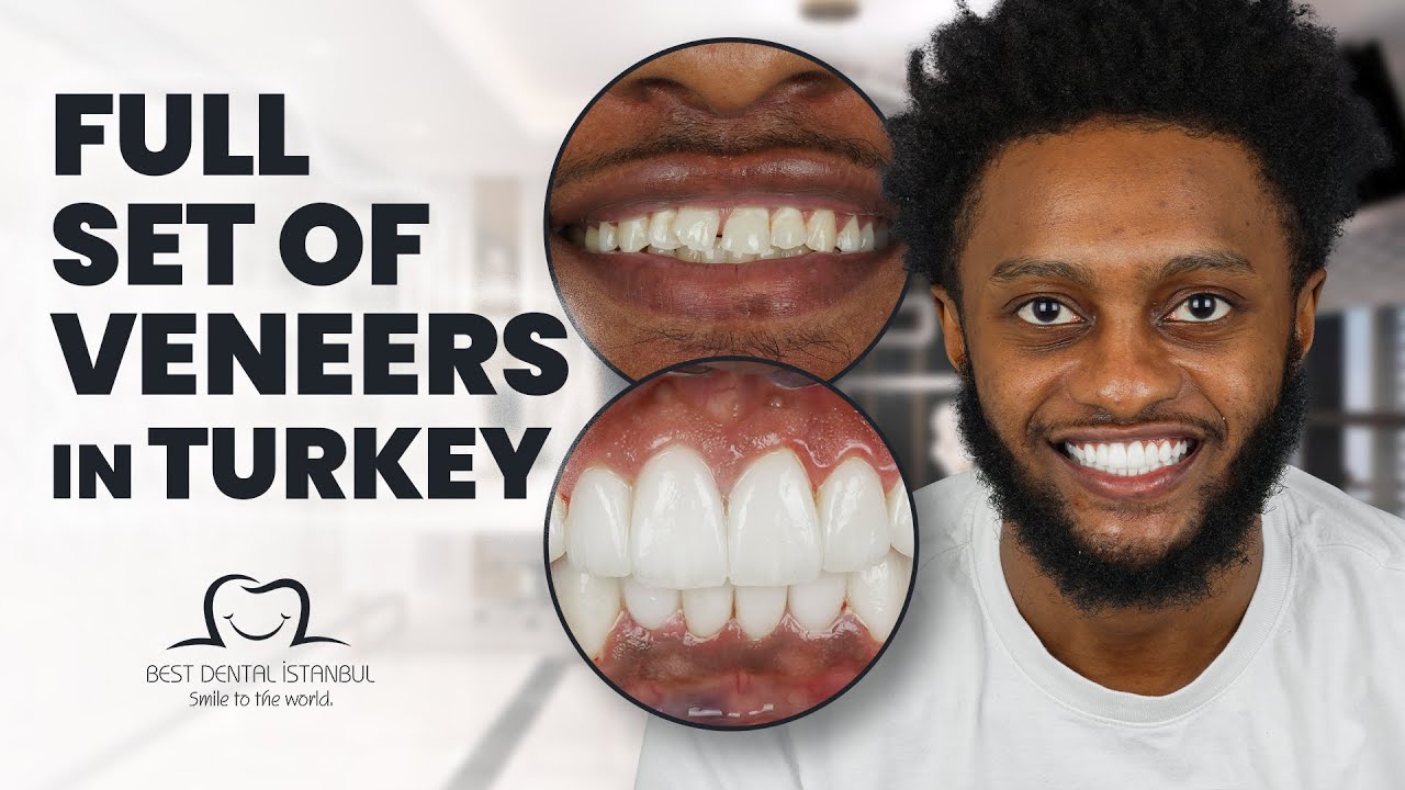 Full Set of Veneers and Crowns- Dental Clinic Turkey