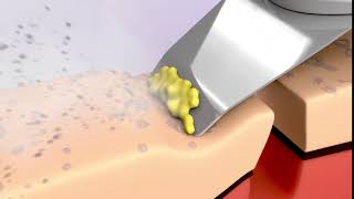 Ultrasonic Skin Spatula Cleansing | Ultrasonic Skin Scrubber Spatula | Blackhead Removal Exfoliation screenshot 5