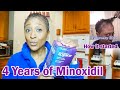 UPDATE - Minoxidil - 4 YEARS LATER / TV Blake Review