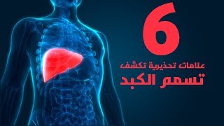 6 علامات تحذيرية تكشف تسمم الكبد