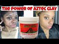 INDIAN AZTEC CLAY AND TURMERIC FACE MASK | BEST ACNE and HYPERPIGMENTATION TREATMENT