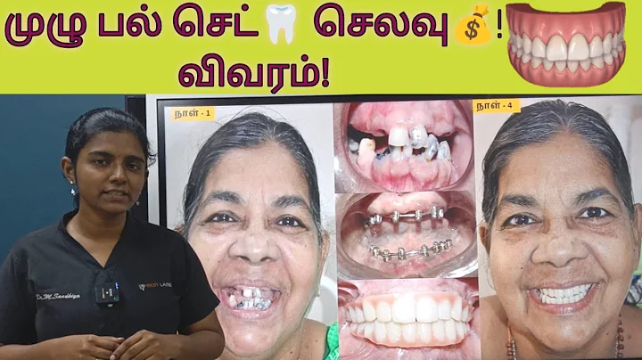 முழு fixed பல் செட் இம்பிளான்ட் மூலம் செயல்முறை மற்றும் செலவு விவரம் / Full set teeth implant cost