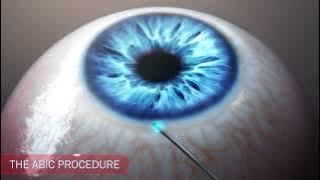 Ophthalmology glaucoma IOP drainage animation