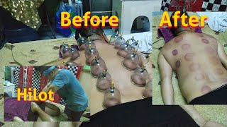 HIJAMA (VENTOSA) NG SAUDI ARABIA WITH PINOY HILOT IN JEDDAH | Be Cool Express The Uragon.