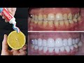 Sadece 2 Dakika İçinde Sarı Kirli Dişler Süt Gibi Beyaz ve Parlak Hale Gelecek | Evde diş tedavisi..