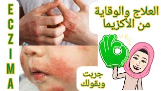 علاج الأكزيما نهائي الوقاية منها وخلاصة تجربتي الشخصية #جلدية #take_action #حساسية #الاكزيما #eczema